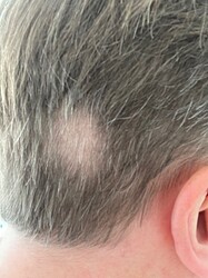AlopeciaAreata